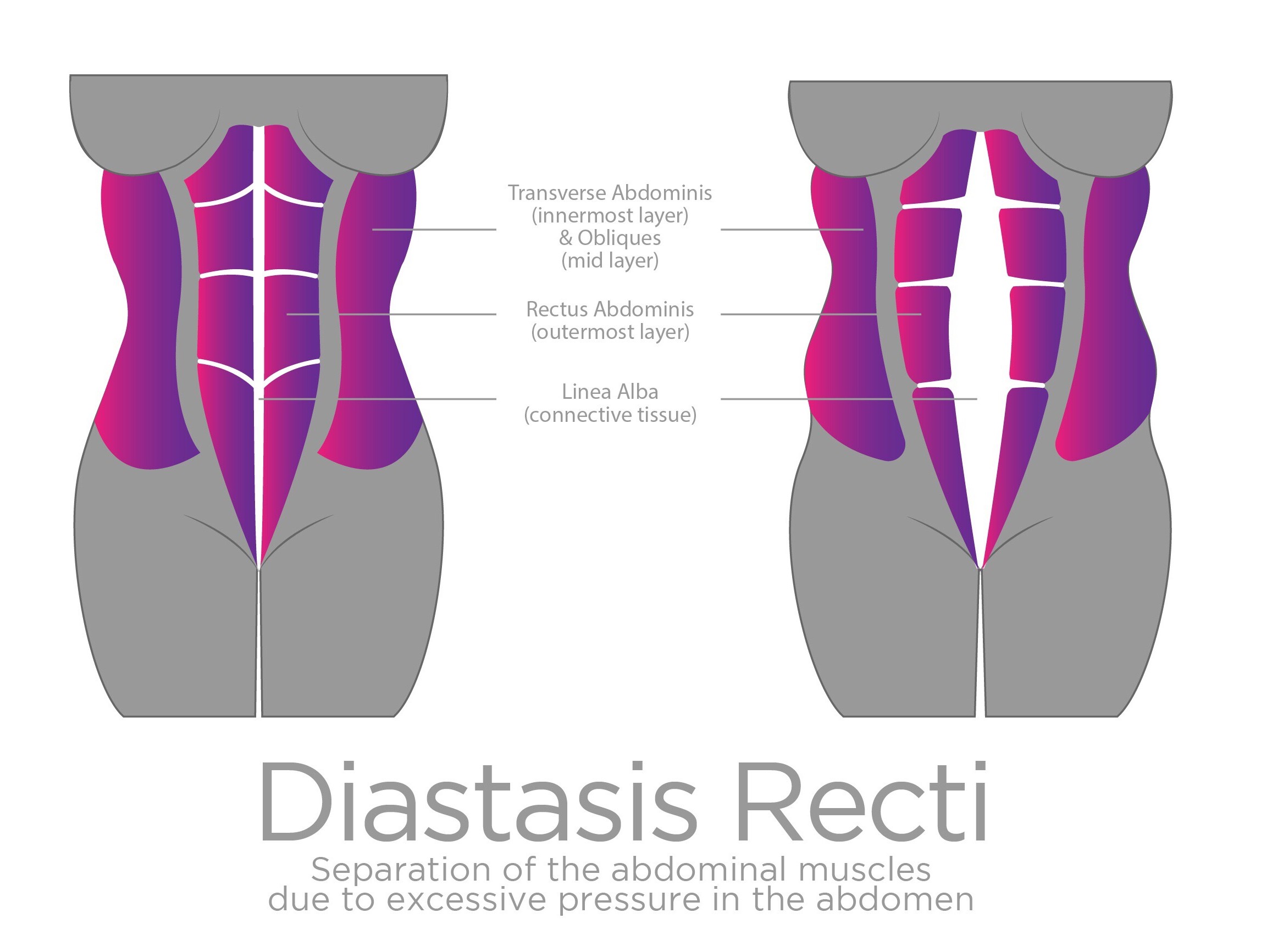 Diastasis Rectus Abdominis & the Implications for Low back & Pelvic He –  PHS Courses