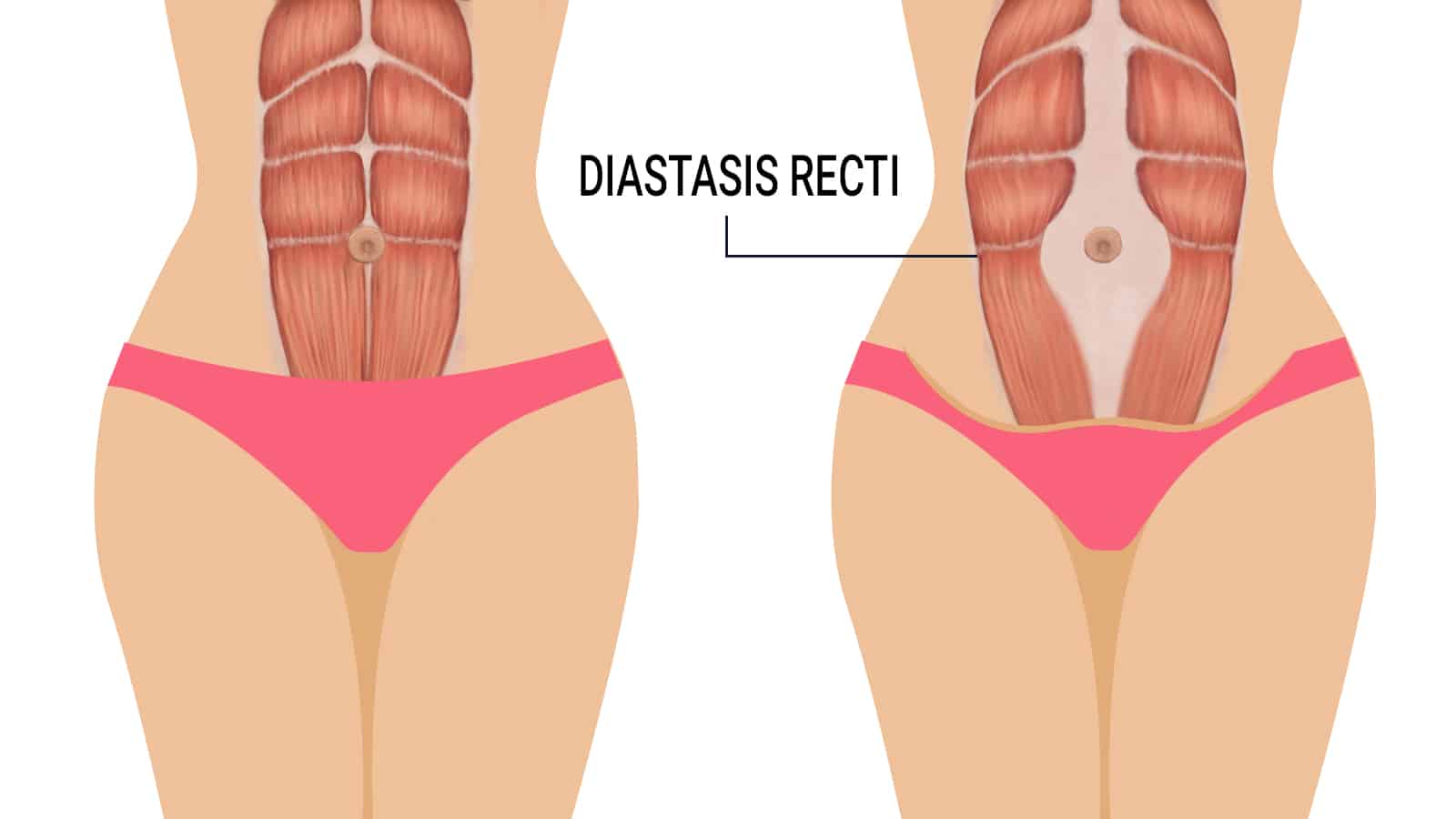 What is Diastasis Recti? - Fix Diastaisis Recti in Scottsdale AZ